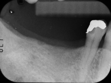 歯の移植・再植のご相談は新鎌ヶ谷の「新鎌ヶ谷歯科」へ。